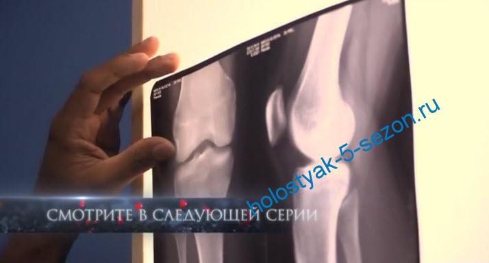 Рентген ноги Леси Рябцевой 2 серия шоу Холостяк 5 ТНТ